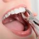 کشیدن دندان قبل از انجام ارتودنسی